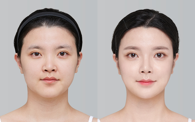 전후사진