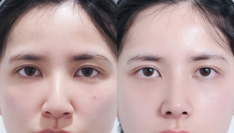 전후사진