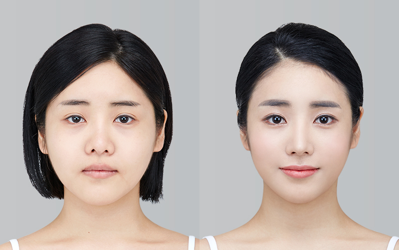 전후사진